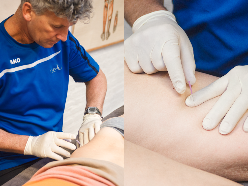 behandelen van Dry Needling Den Helder